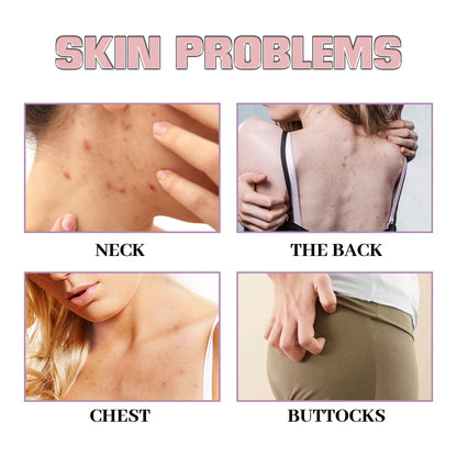 Acne Acne Ball, And Cleansing Skin Chest Back Acne Closing Skin Care