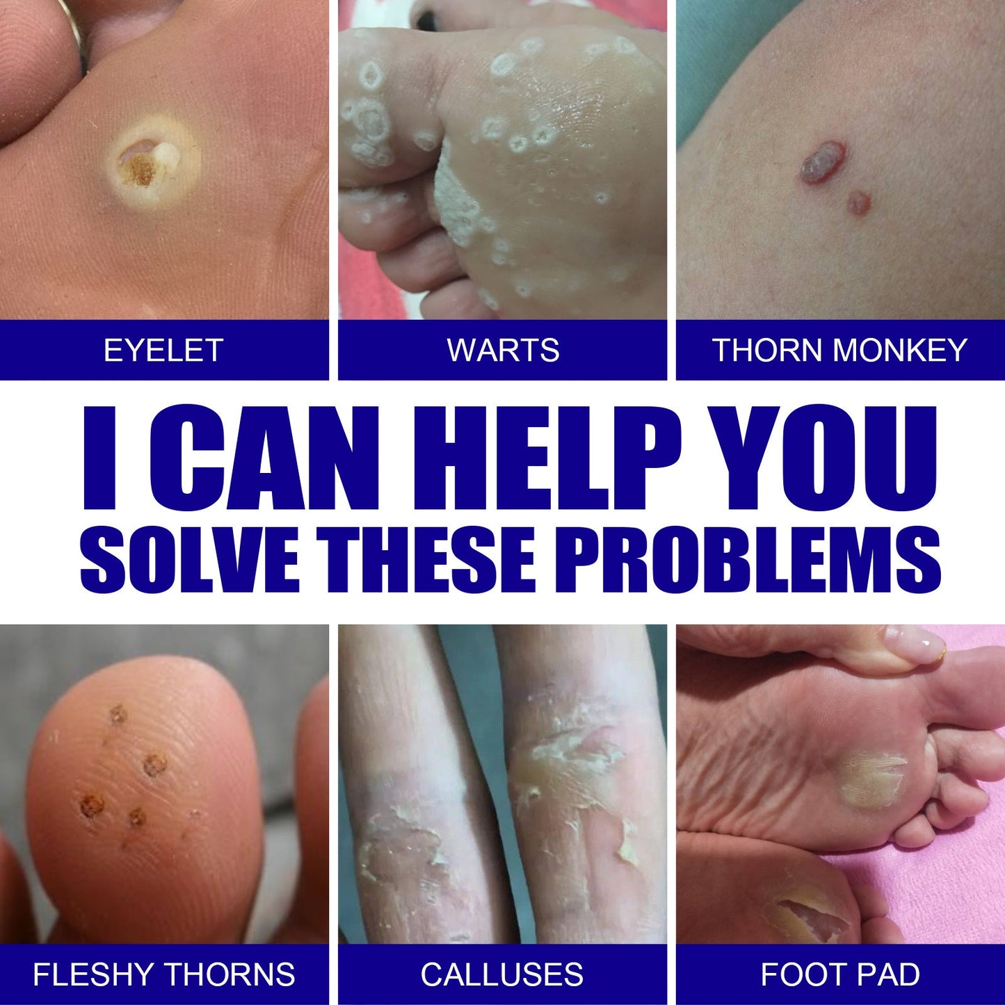 Wart Remover Ointment, Remove Hou Warts Flat Corn Plaster Flat Grains Warts, Foot And Repair Skin Dot Mole G Wart Cream