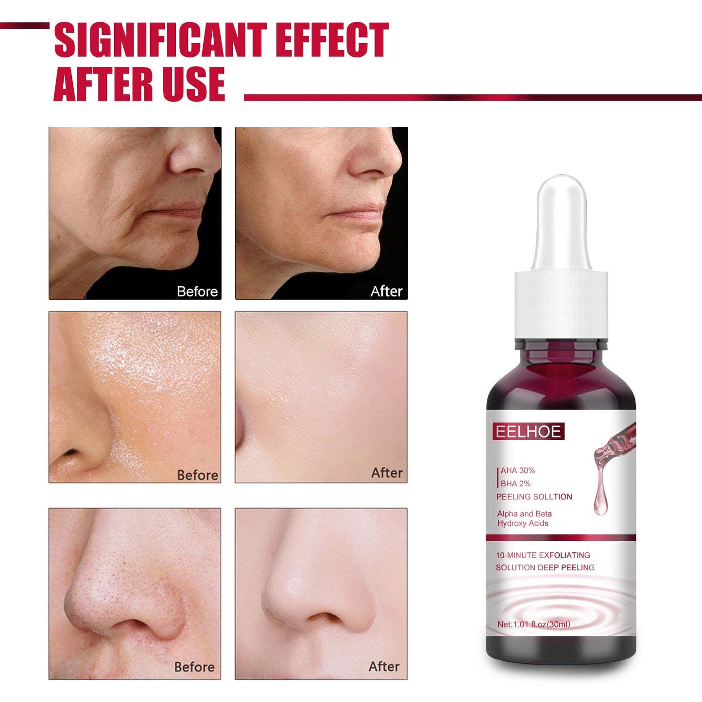 AHA30% + BHA 2% Fruit Acid Salicylic Acid Essence, Exfoliating Cleaning Blackheads Acne And Shrinking Pores Essence