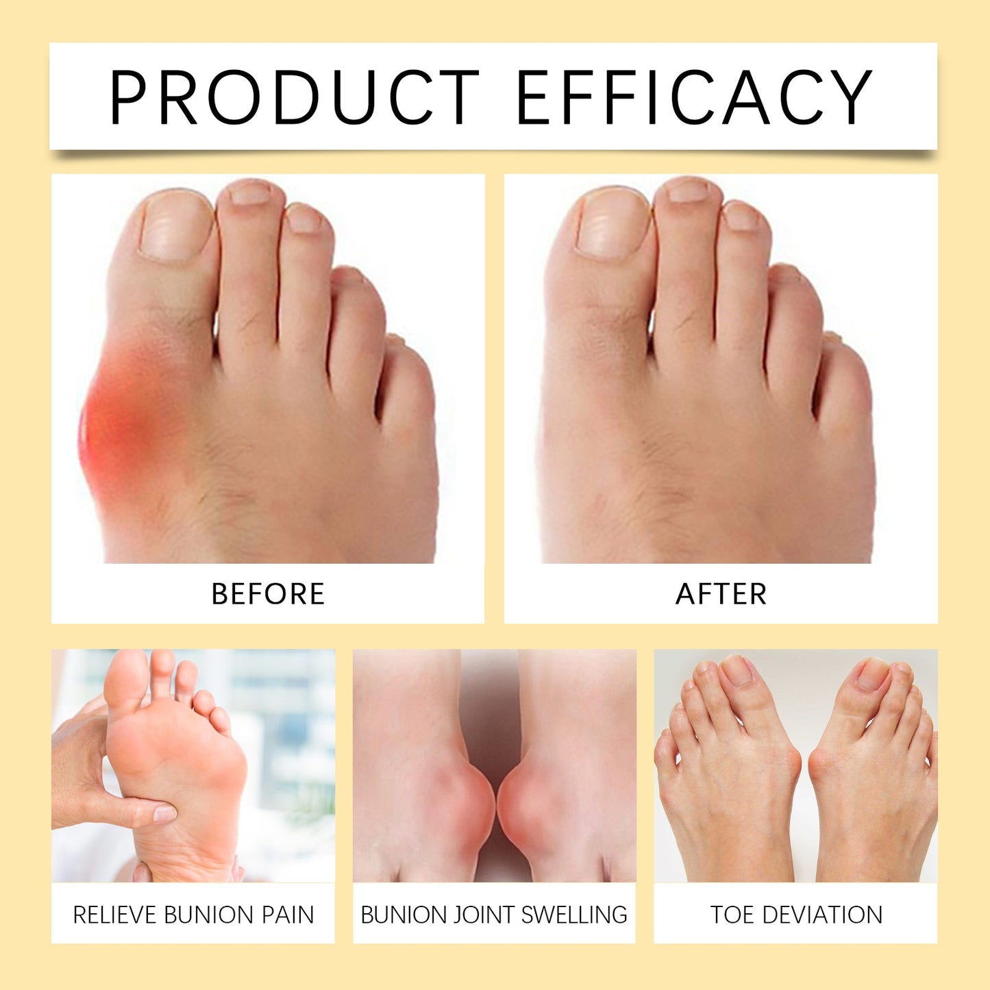 Bee Venom Care Cream, Bee Venom Care Cream To Relieve Inflammation, Pain Swelling Can Improve Joint Health Bunions Adjuvant Therapy