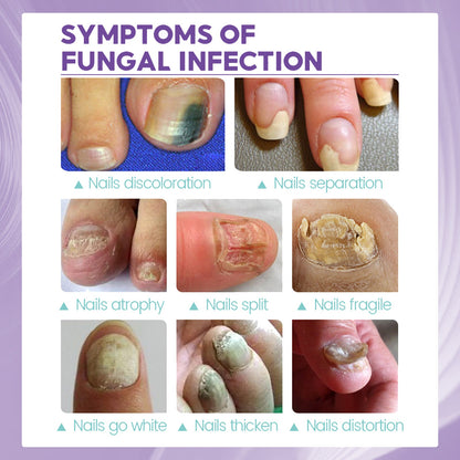 Gray Nail Care Spray Soft Ingrown Nails, Ingrown Nails, Yellowing And Thickening Cleaning Care