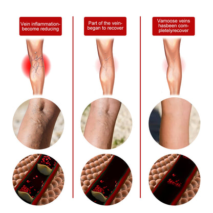 Intravenous Massage Spray For Varicose Veins Relief And Earthworm Leg Blood Vessel Bulge Pain Spray